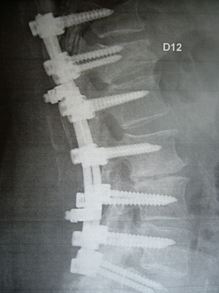 Arthrodèse vertébrale D11-L5