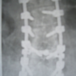 Arthrodèse vertébrale D11-L5 de face