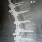 Arthrodèse vertébrale D11-L5