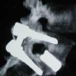 Arthrodèse vertébrale postérieure et intersomatique L5-S1