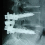 Arthrodèse vertébrale L4-L5