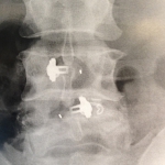 Double ligamentoplastie L3-L5