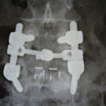 Arthrodèse post et intersomatique L4-L5