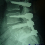 Stabilisation mixte L3-S1 de profil